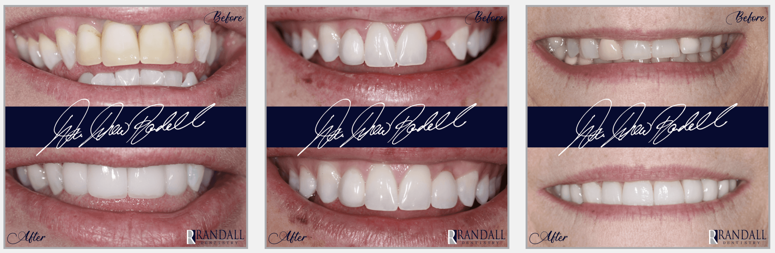 Screen Shot 2024-01-20 at 8.16.05 PM porcelain veneers university park tx