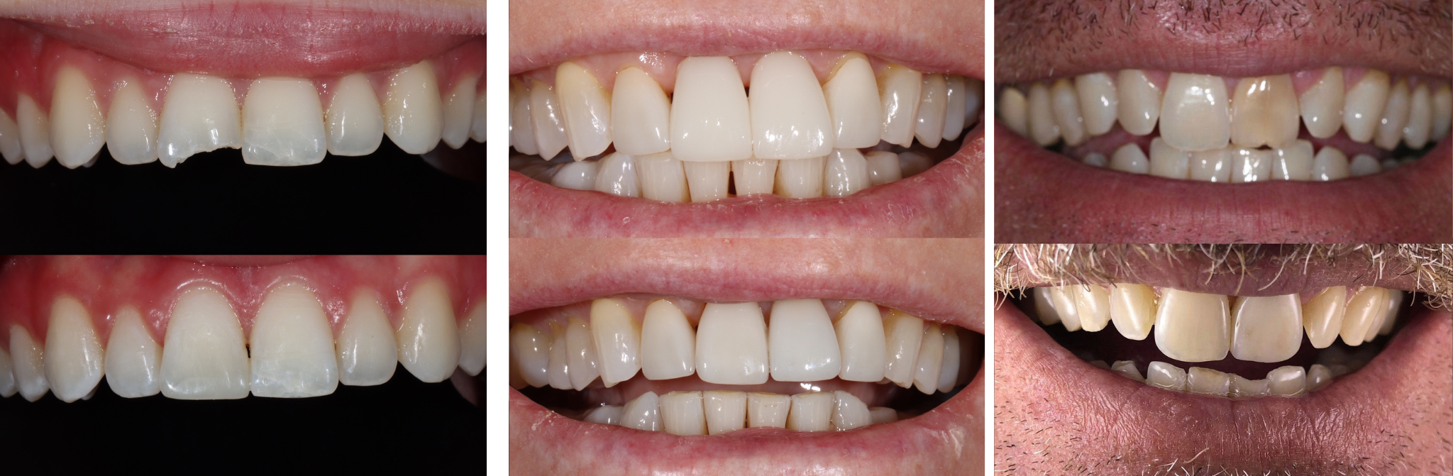 Untitled design (18) Dental crowns university park tx