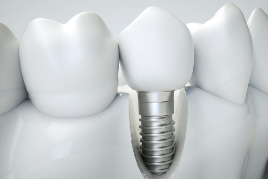 dental implant procedure