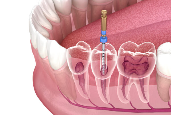 root canal