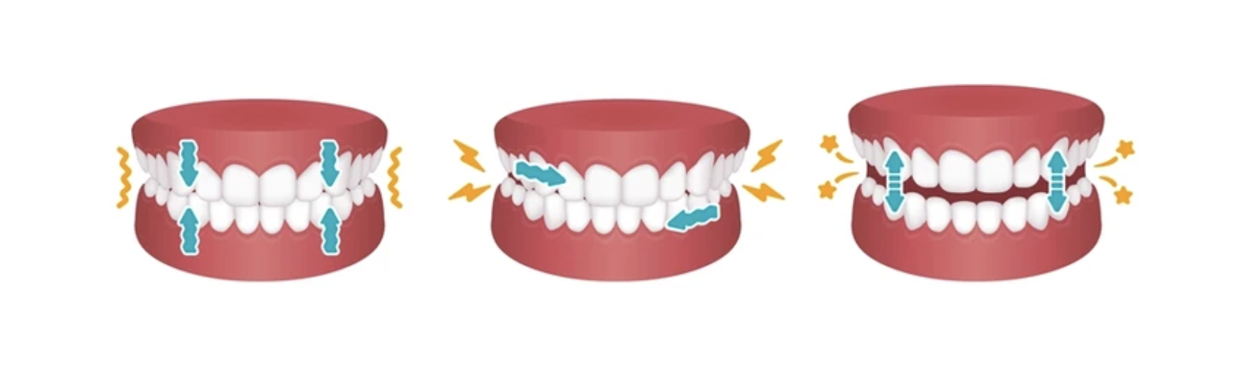 teeth grinding bruxism