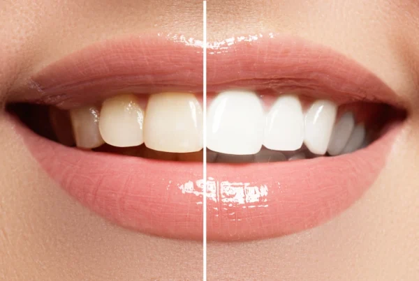 Exploring Natural and Organic Teeth Whitening Options