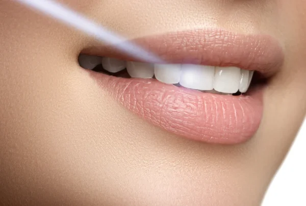 Custom Tray Whitening: A Safe and Effective At-Home Option